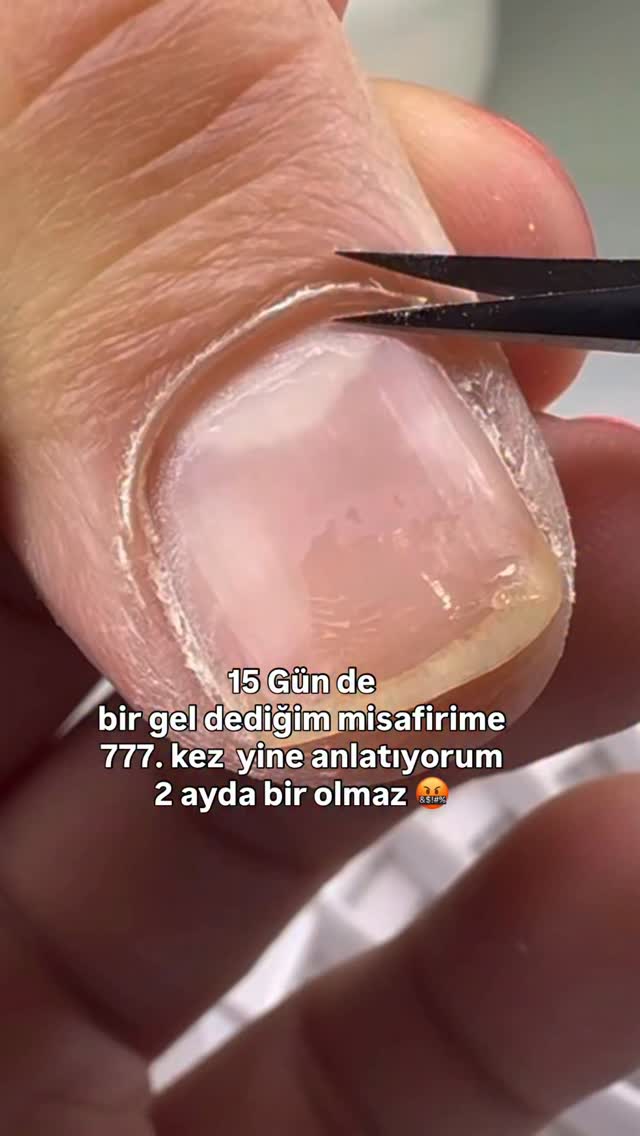 Sebebi ? Tırnak geç ve cansız  uzar 👍