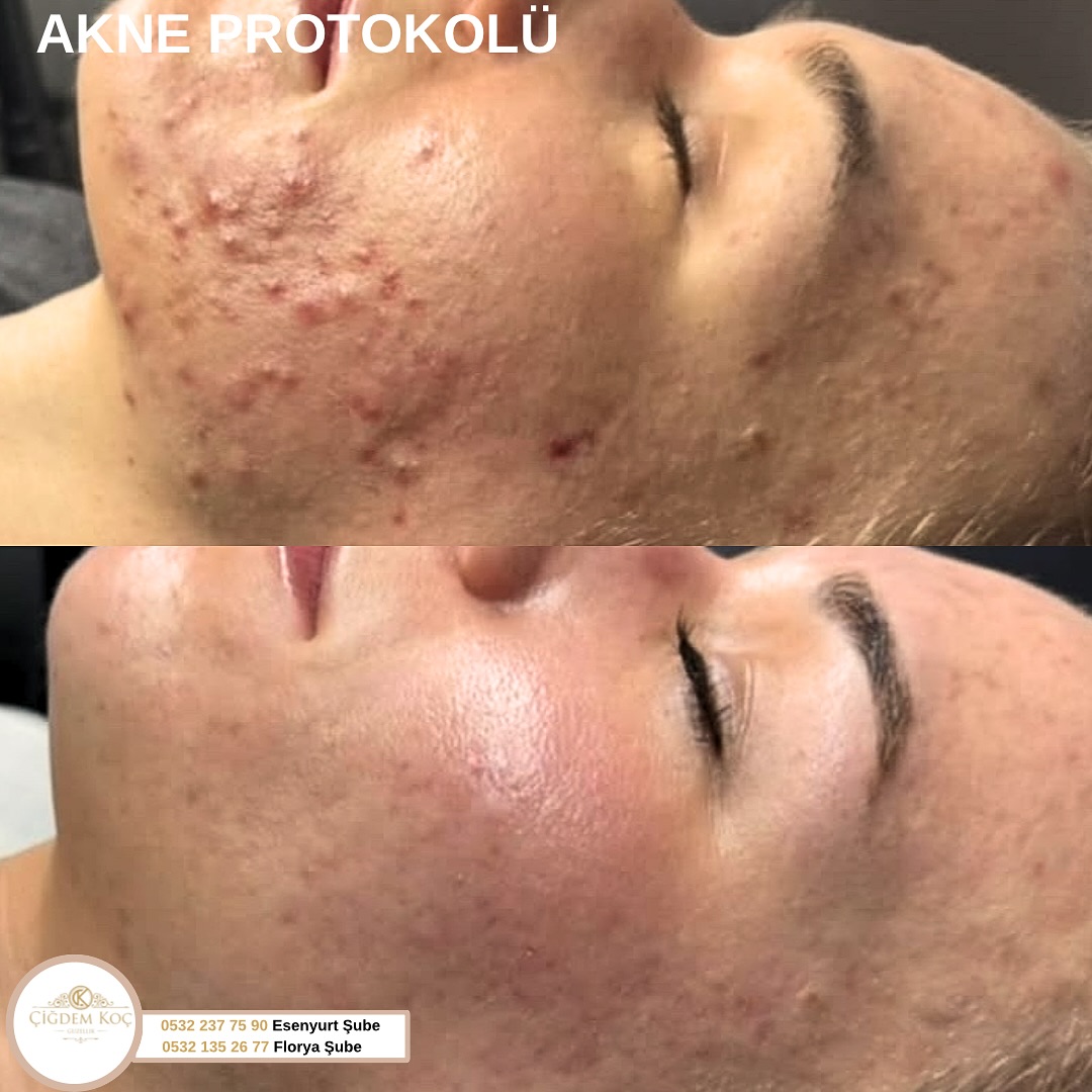 8 Farklı Cilt Protokolü 💫
Kişiye Özel Cilt Problemleri İçin Programlar ✨

#akne #ciltbakımürünleri #sivilce #gözenek #leke