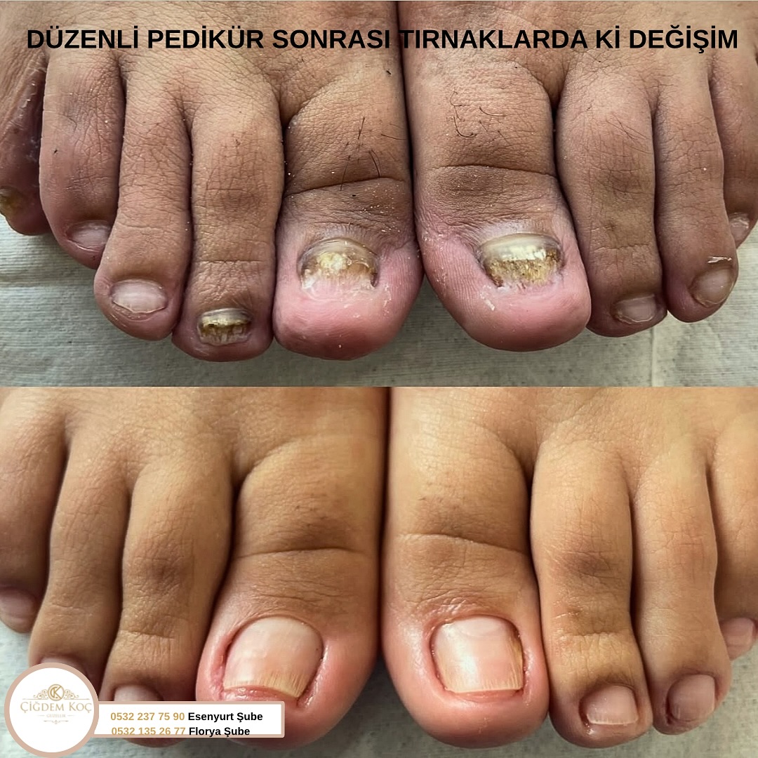 Sizlerde farklı Tırnak Problemleriniz için bizimle iletişime geçebilirsiniz 🌸

-batık tırnak 
-sararmış tırnak 
-mantar tırnak 
-kalınlaşmış tırnak 
-sertleşmiş topuk vb problemler için spa konforuyla tertemiz ayaklar 🌸

#batıktırnak #tırnakmantarı #pedikur #tırnakbatması