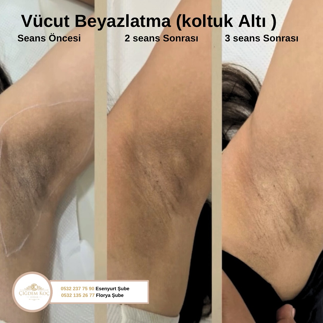 Vücut Beyazlatma ile sizlerde özel bölge yada farklı bölgelerde oluşan kararmalarınız için bizimle iletişime geçebilirsiniz 🌸

#koltukaltıkararması #leke #vücutbeyazlatma #genitalbölgebeyazlatma